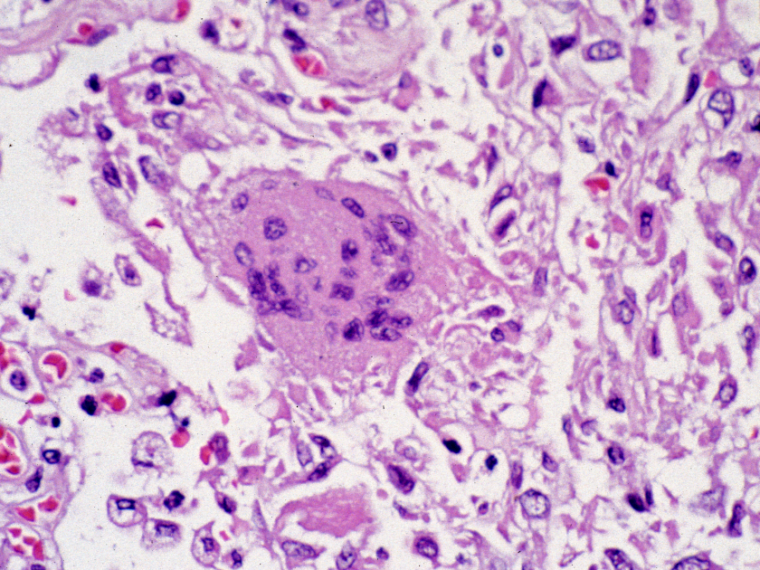 Specimen of lung tissue affected by SARS